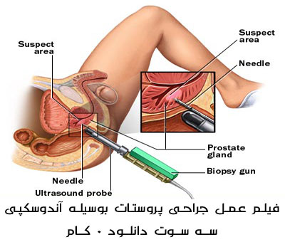 فیلم جراحی پروستات بوسیله آندوسکوپی